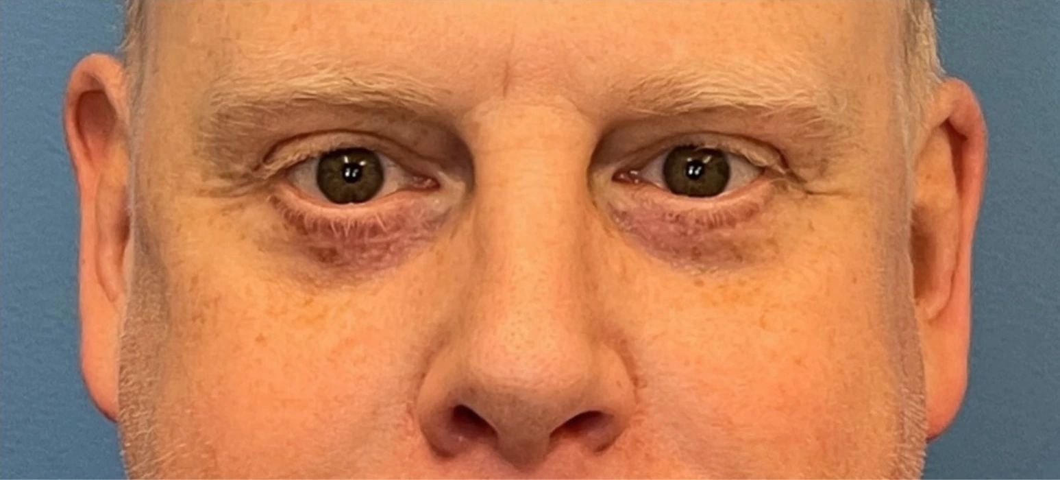 Lower-Blepharoplasty-Case--289 | After Eyelid Surgery 1