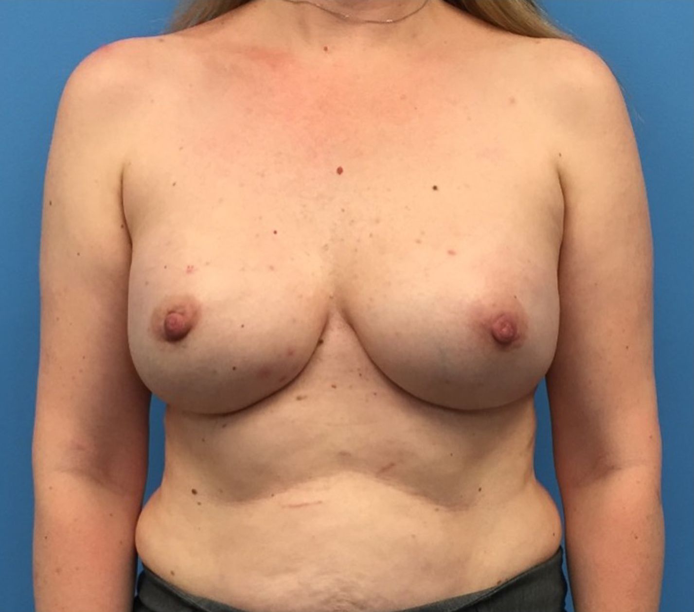 Breast-Reconstruction-Case--295 | After Breast 1
