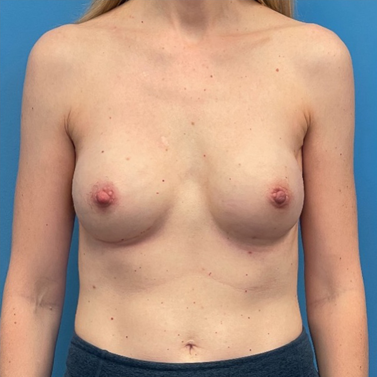 Breast-Reconstruction-Case--298 | After Breast 1