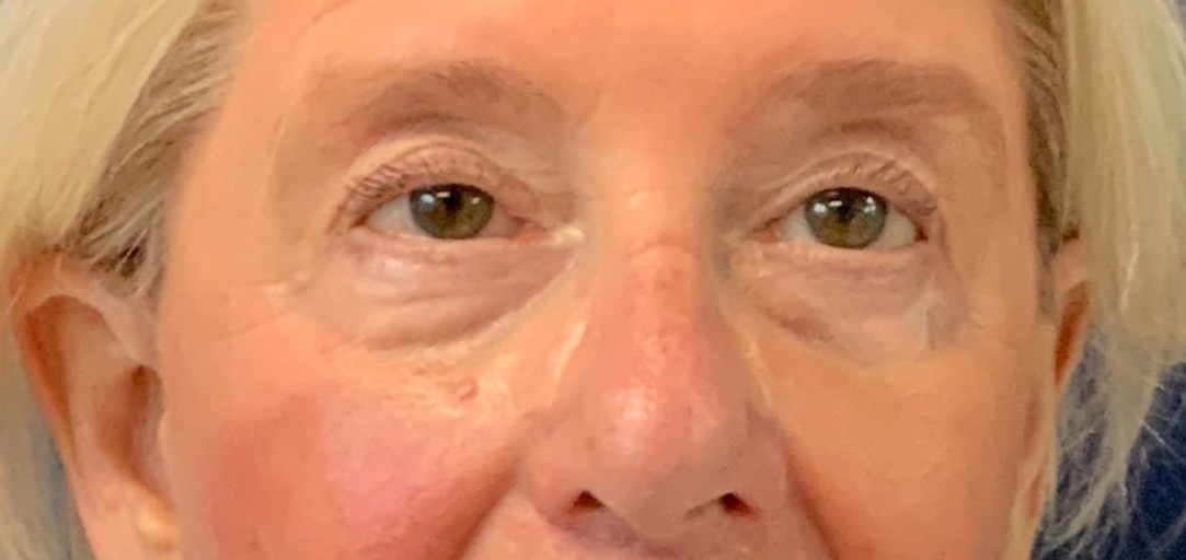 Blepharoplasty-Case--4349 | After Eyelid Surgery 1