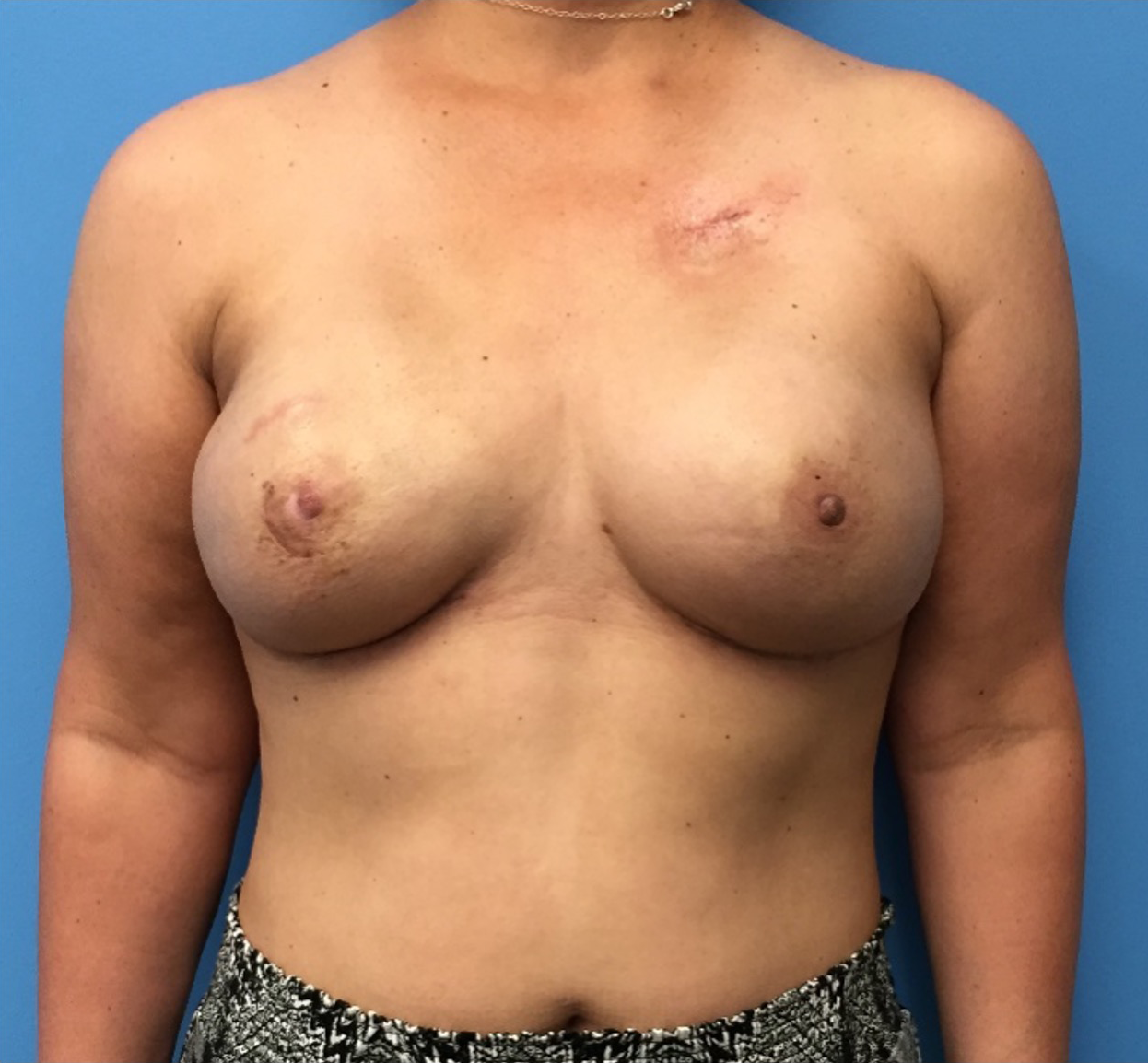 Breast-Reconstruction-Case--400 | After Breast 1