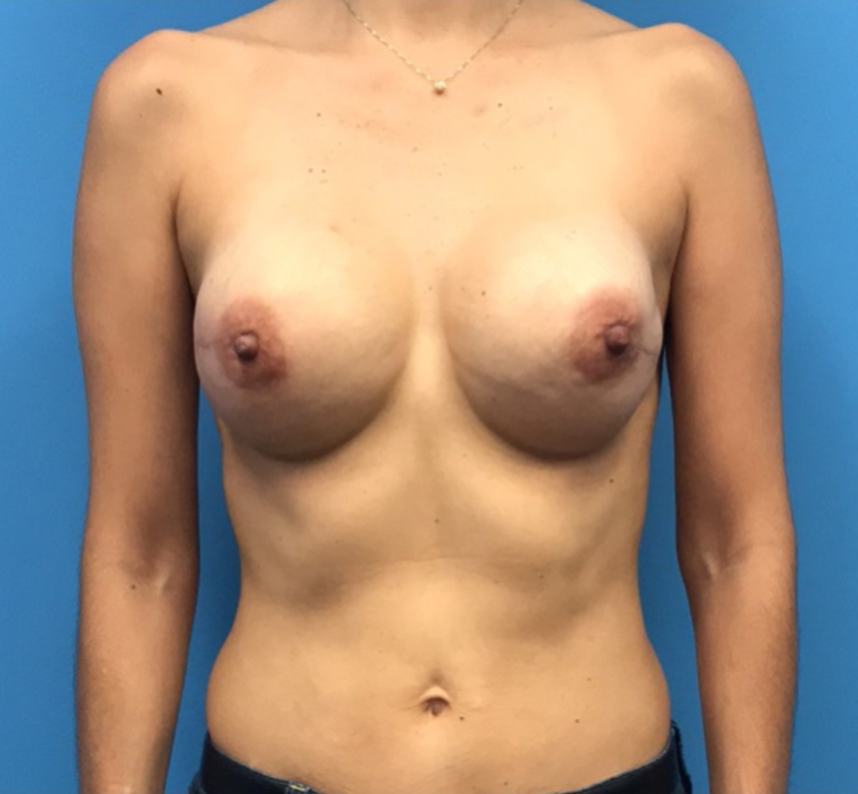 Breast-Reconstruction-Case--304 | After Breast 1