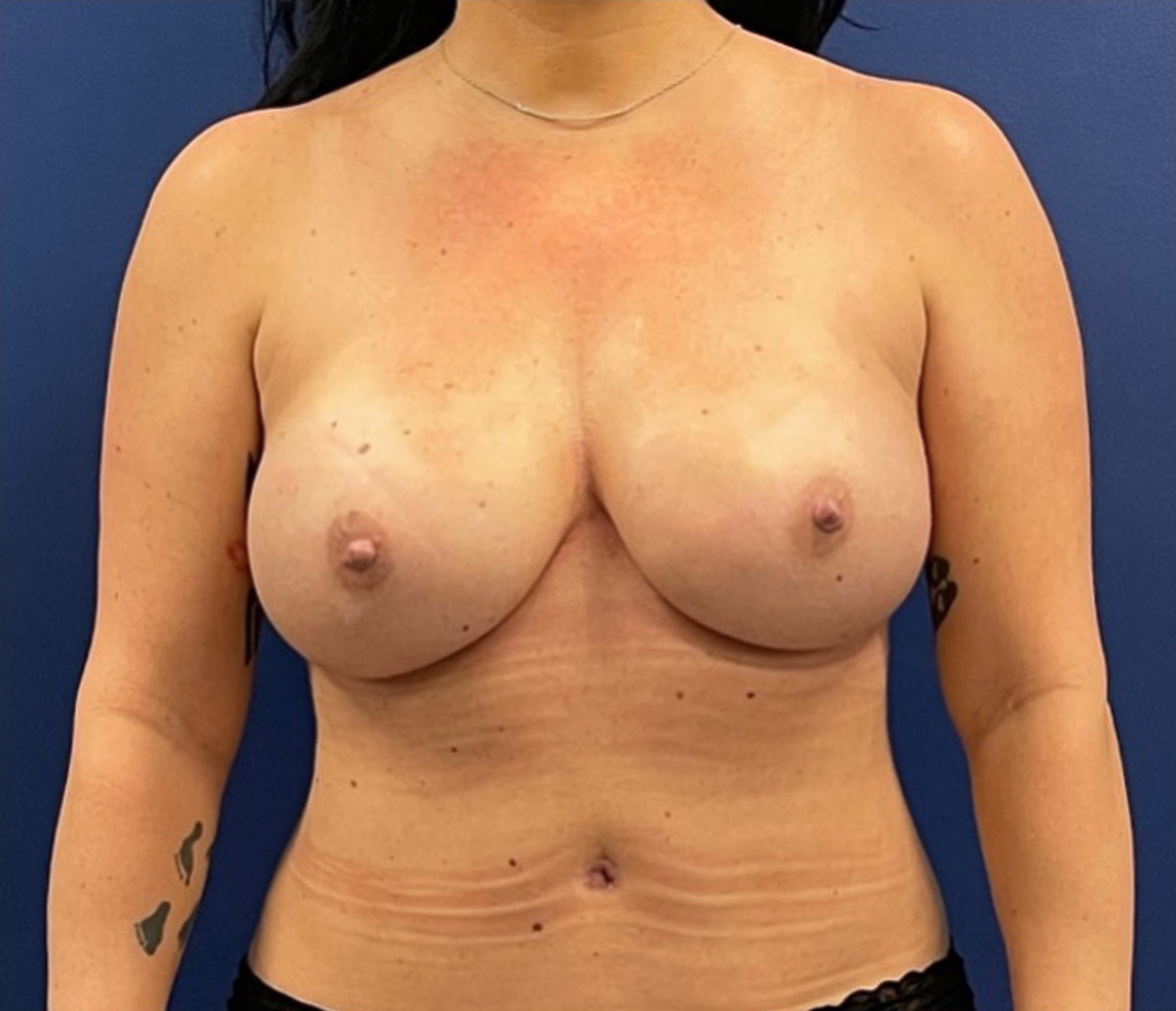 Breast-Reconstruction-Case--306 | After Breast 1