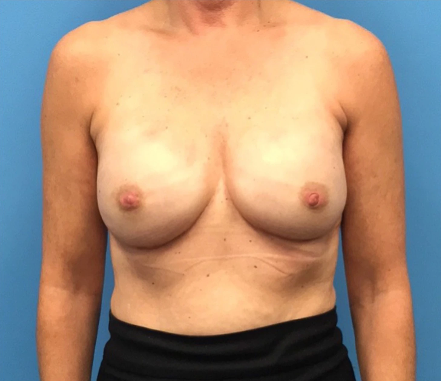 Breast-Reconstruction-Case--310 | After Breast 1