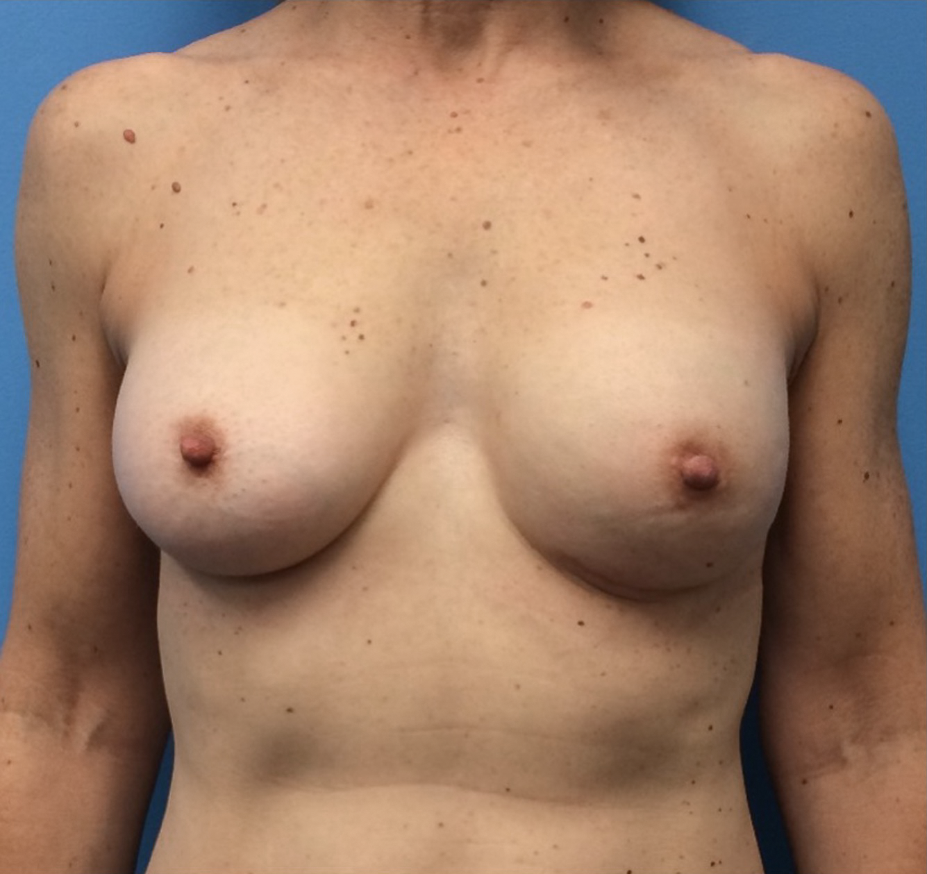 Breast-Reconstruction-Case--312 | After Breast 1