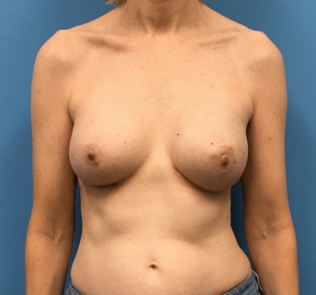Breast-Reconstruction-Case--313 | After Breast 1