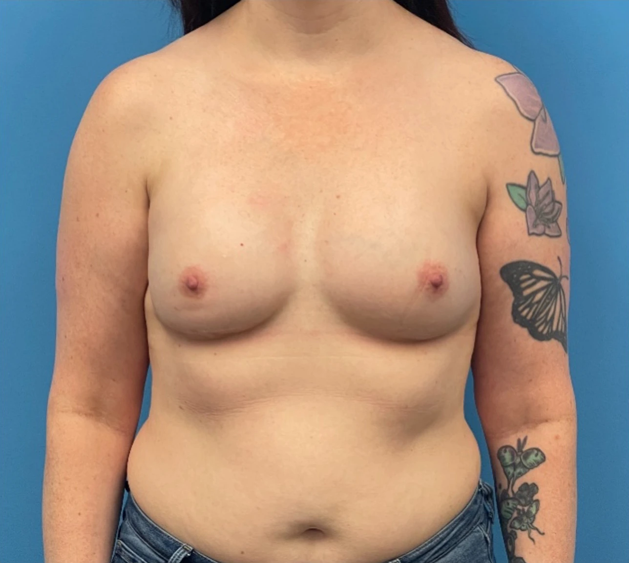 Breast-Reconstruction-Case--335 | After Breast 1