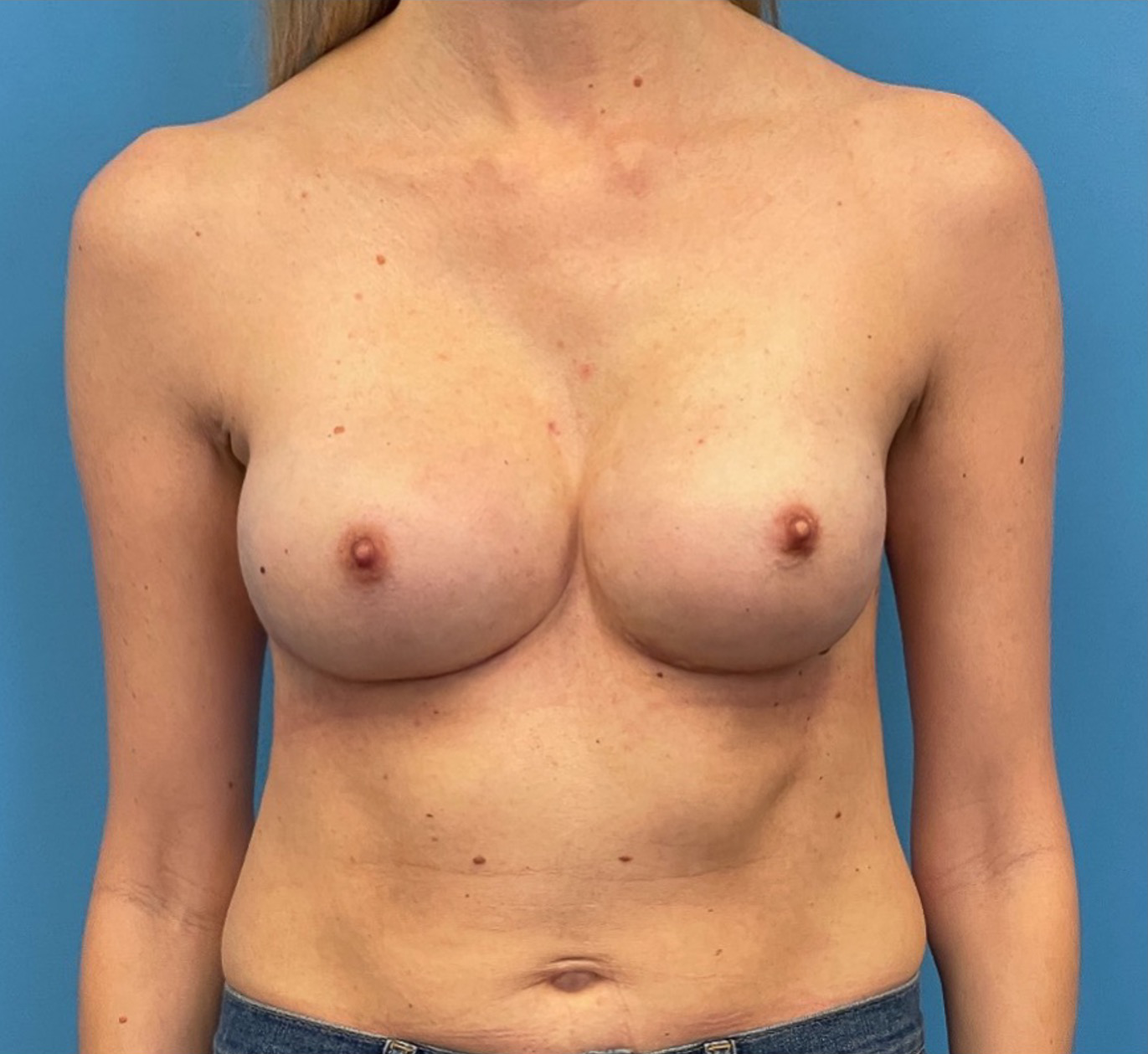 Case--317 | After Breast 1