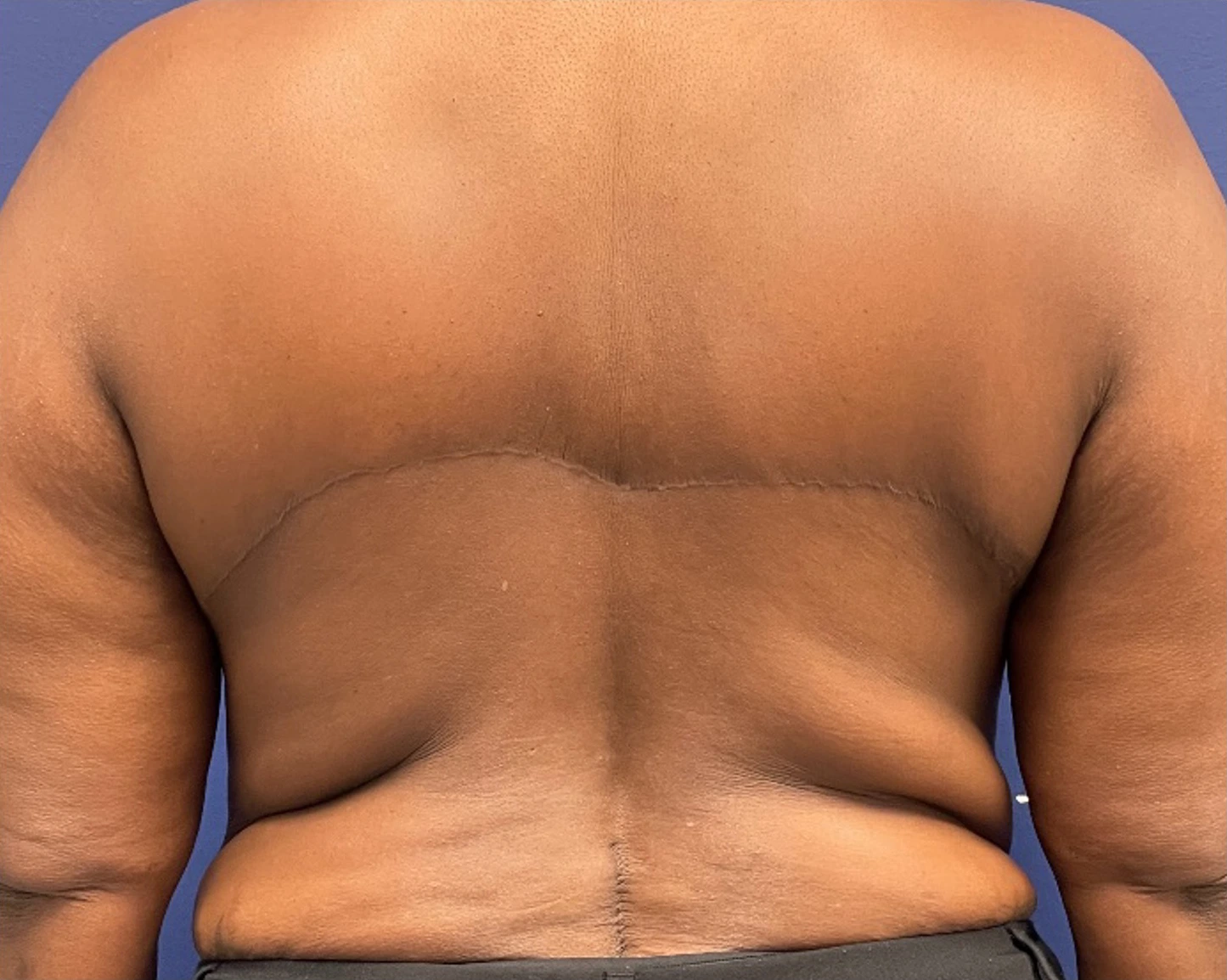Body-Lift-Case--275 | After Body Lift 1