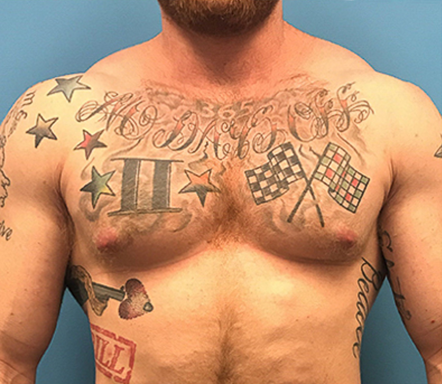 Gynecomastia-Case--143 | After Breast 1