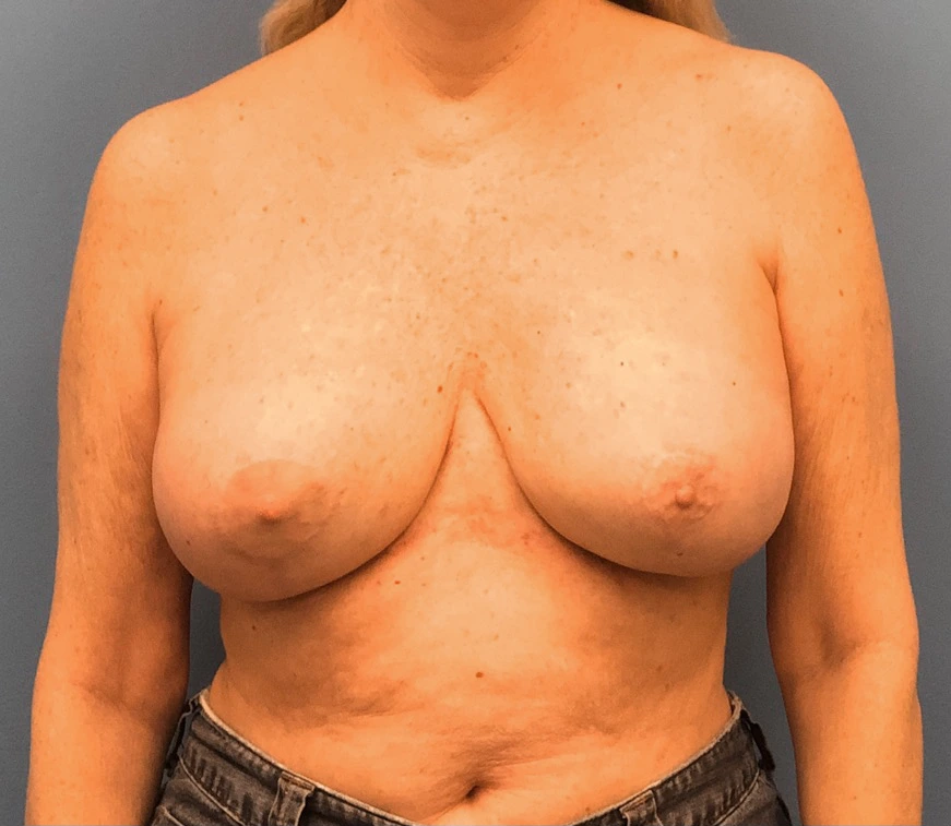 Case--9690 | After Breast 1