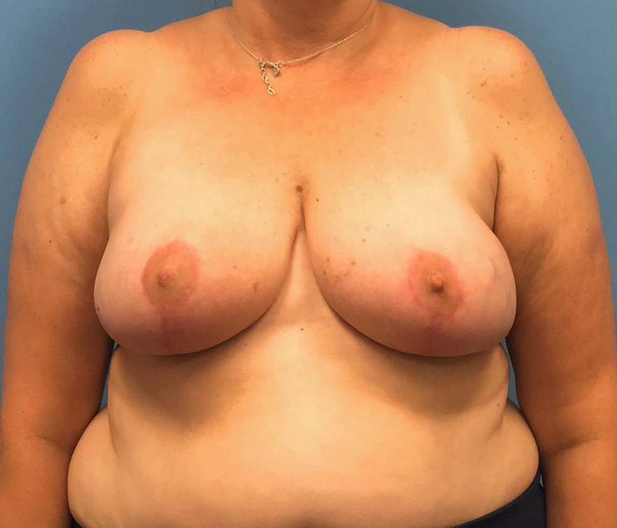 Breast-Reduction-Case--13597 | After Breast 1