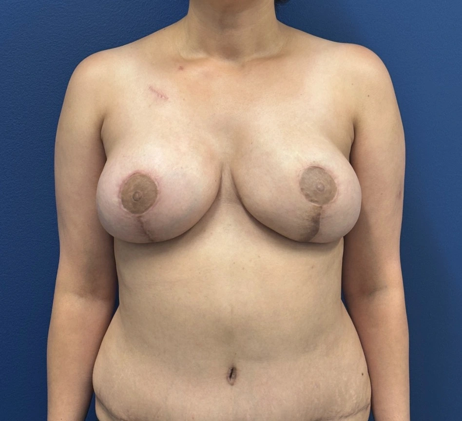 DIEP-Flap-Case--27227 | After Breast 1