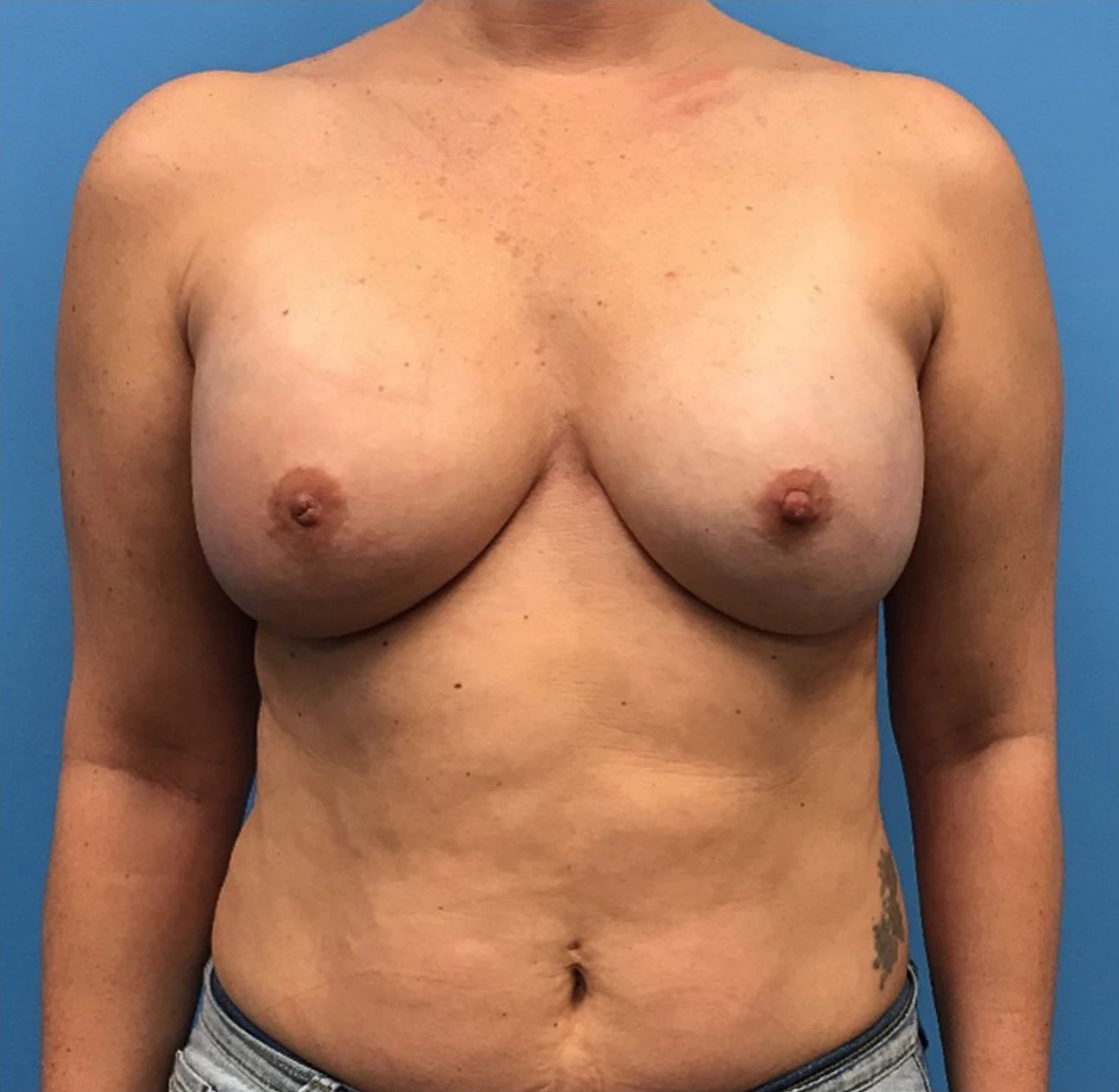 Case--299 | After Breast 1