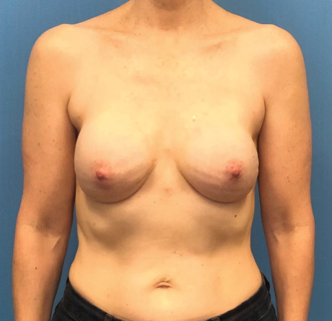 Case--301 | After Breast 1