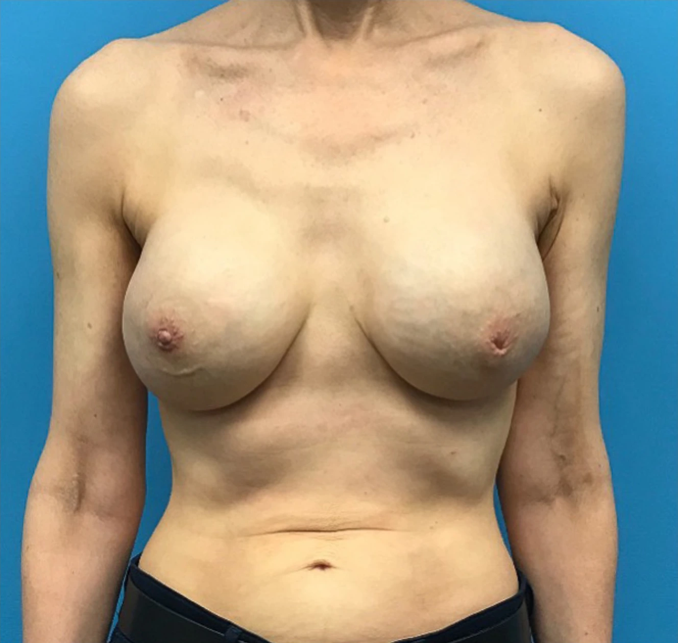 Case--302 | After Breast 1