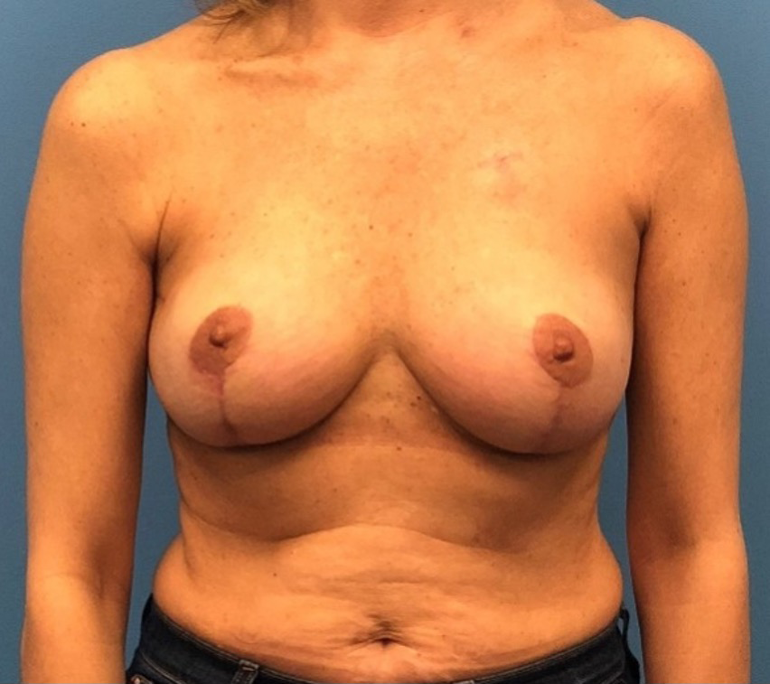 Case--334 | After Breast 1
