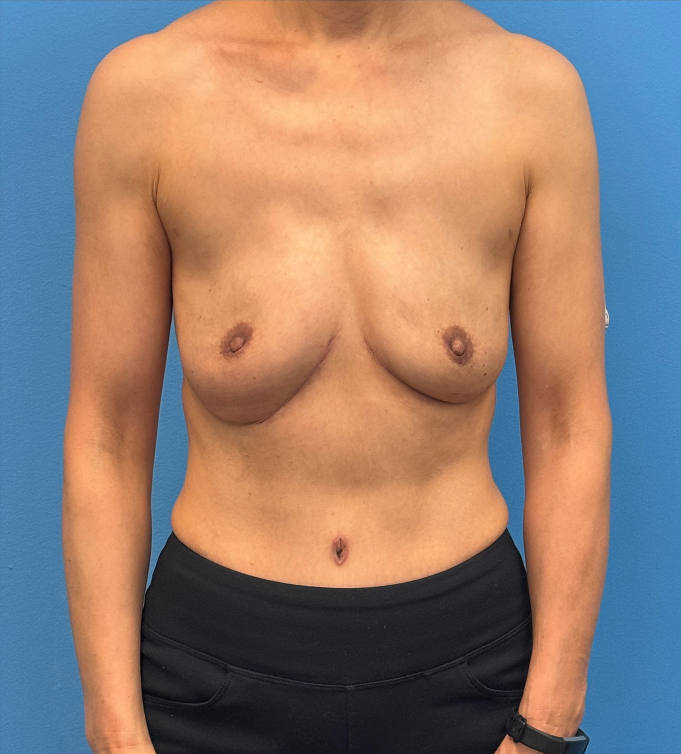 Diep-Flap-Procedure | After Breast 1