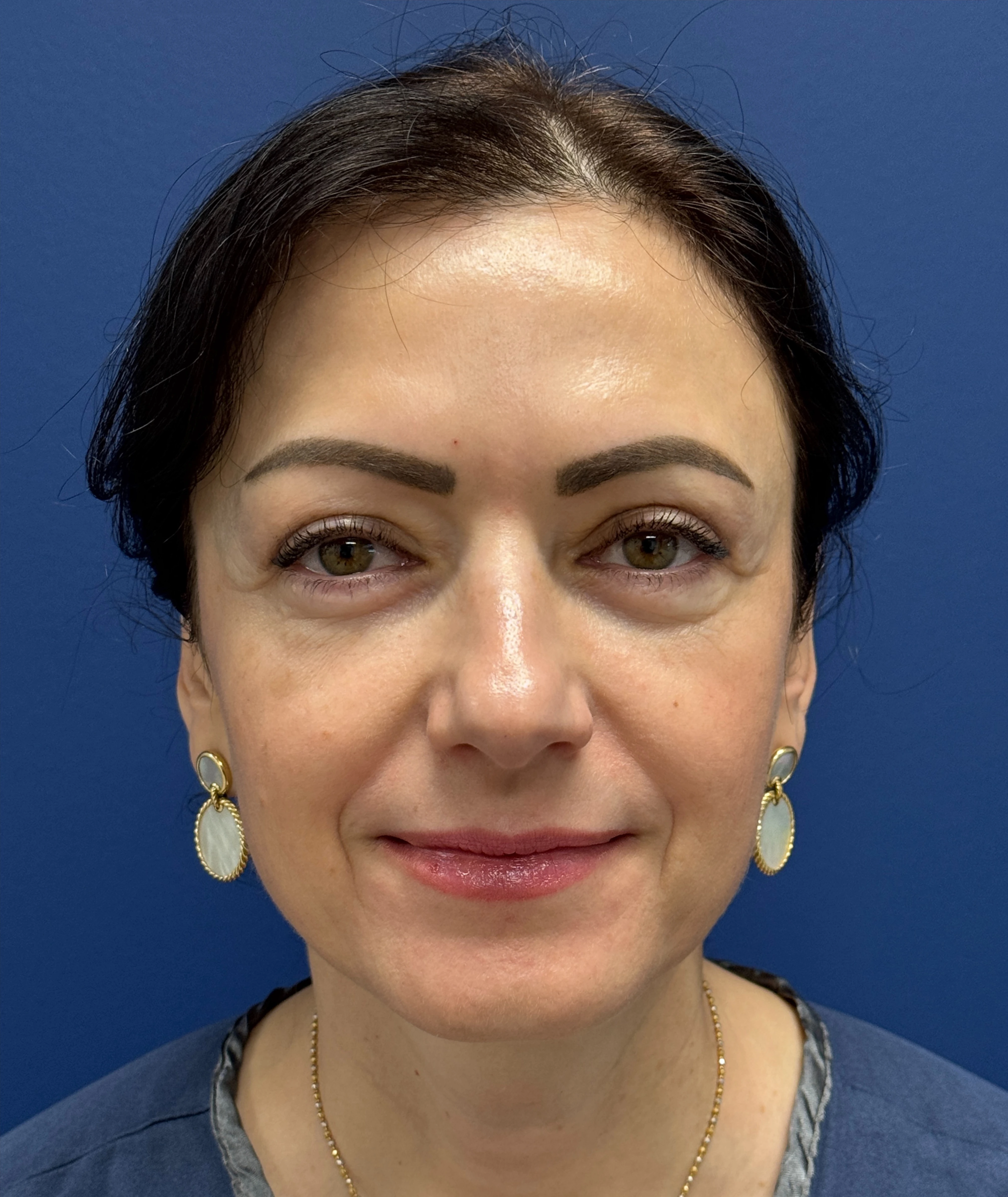 Lower-Blepharoplasty-Case--26939 | After Eyelid Surgery 1