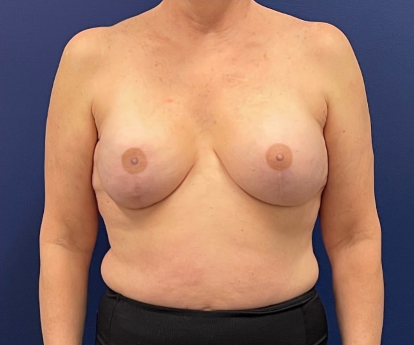 Breast-Reconstruction-Case--308 | After Breast 1