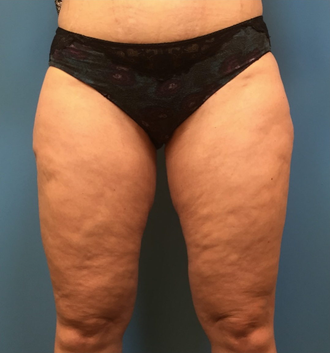 Case--281 | After Liposuction 1