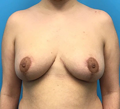 Breast-Reduction-Case--132 | After Breast 1