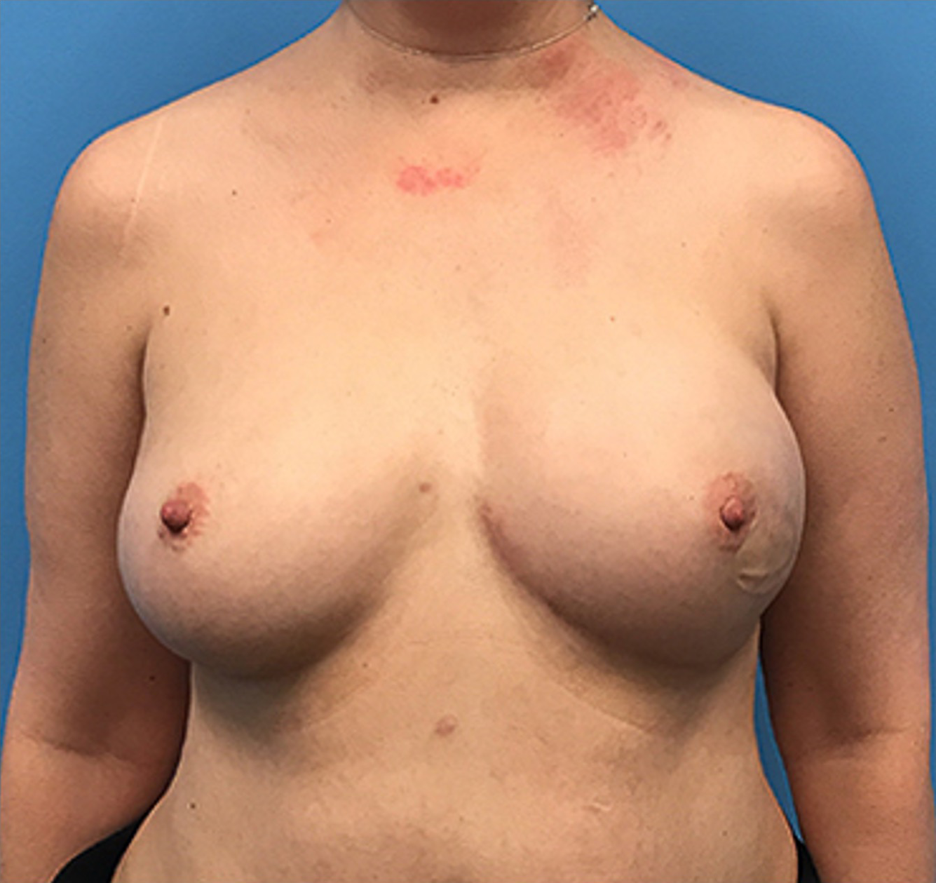 Case--136 | After Breast 1