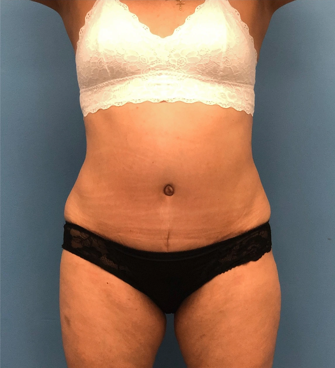 Case--14819 | After Tummy Tuck 1