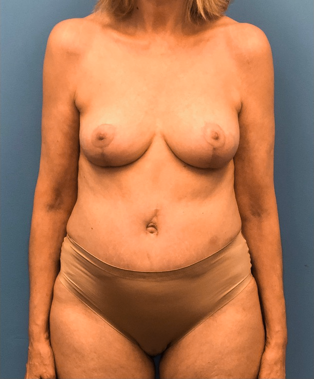Case--17297 | After Breast 1
