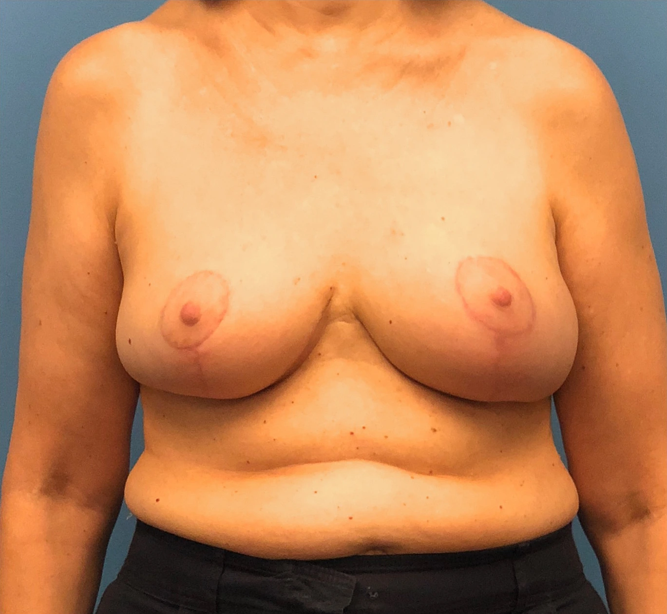 Breast-Reduction-Case--13180 | After Breast 1