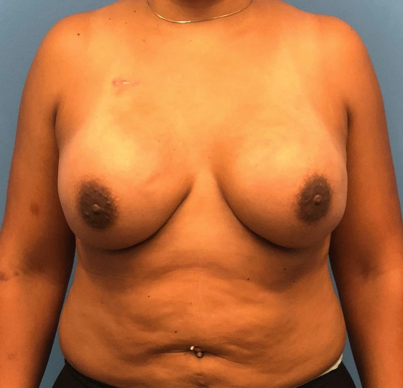 Case--11132 | After Breast 1