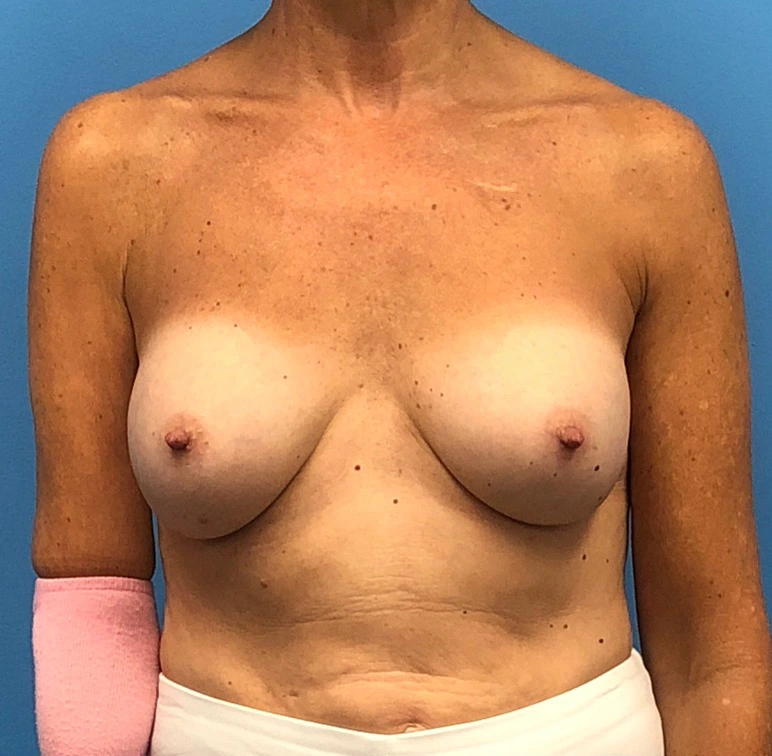 Revision-Augmentation--13287 | After Breast 1