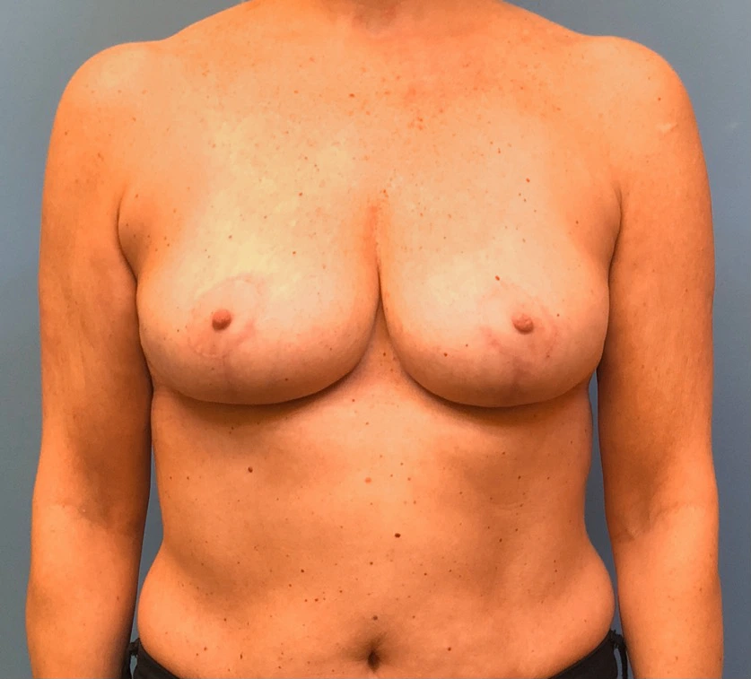 Breast-Reduction-Case--13839 | After Breast 1