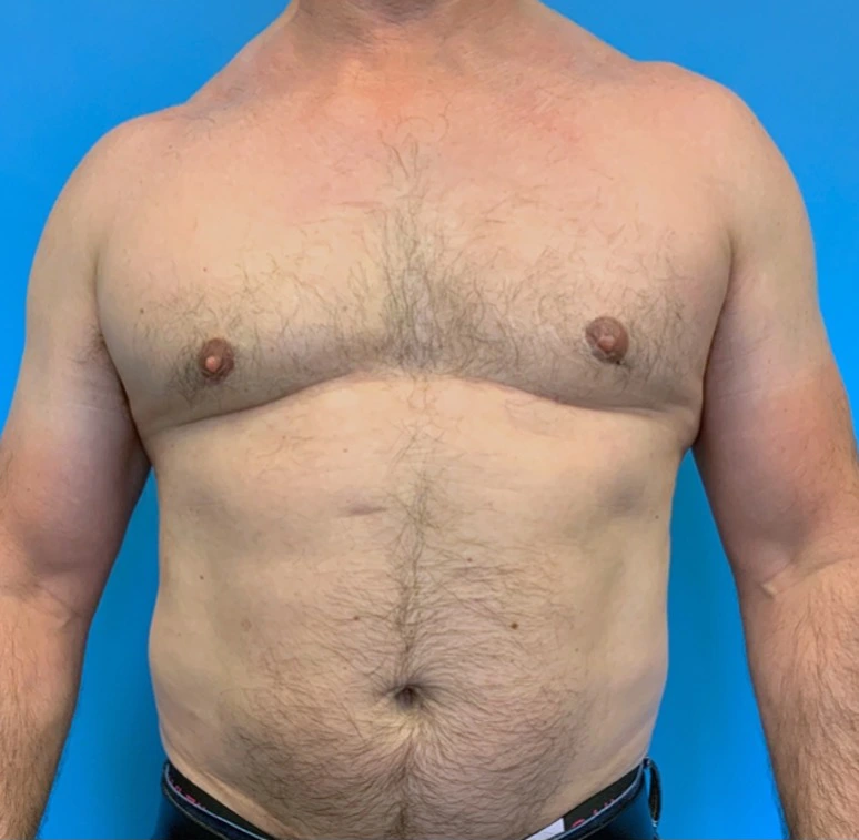 Gynecomastia-Case--20376 | After Breast 1