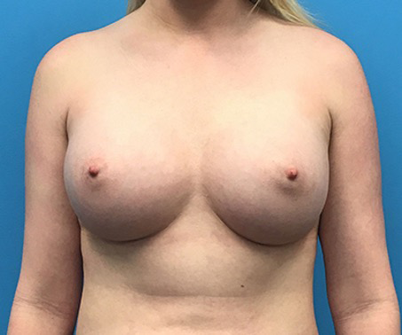 Case--94 | After Breast 1