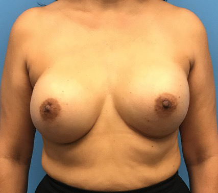 Case--134 | After Breast 1