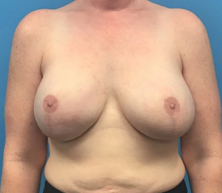 Case--137 | After Breast 1