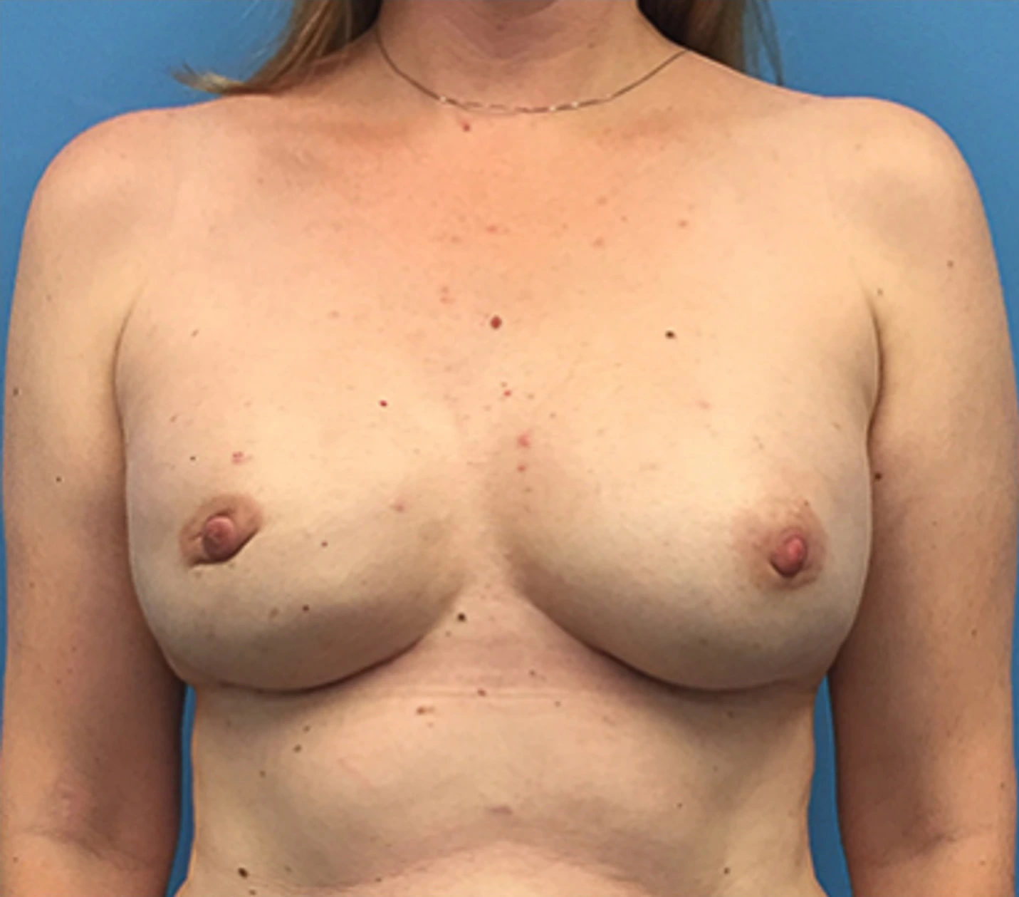 Case--138 | After Breast 1