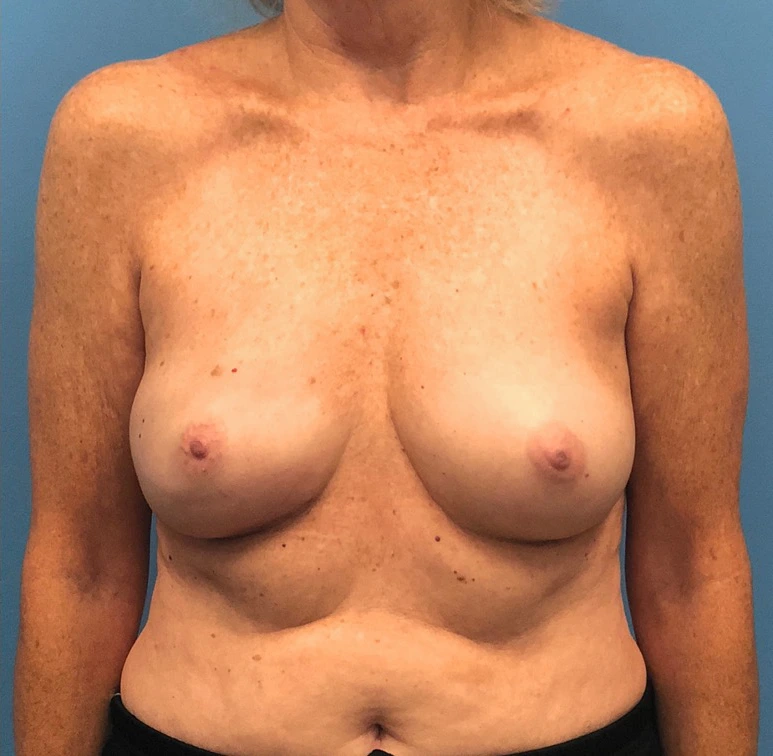 Case--13861 | After Breast 1