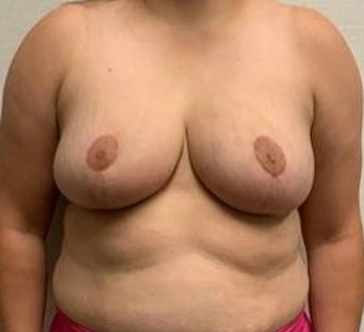 Breast-Reconstruction-Case--26525 | After Breast 1