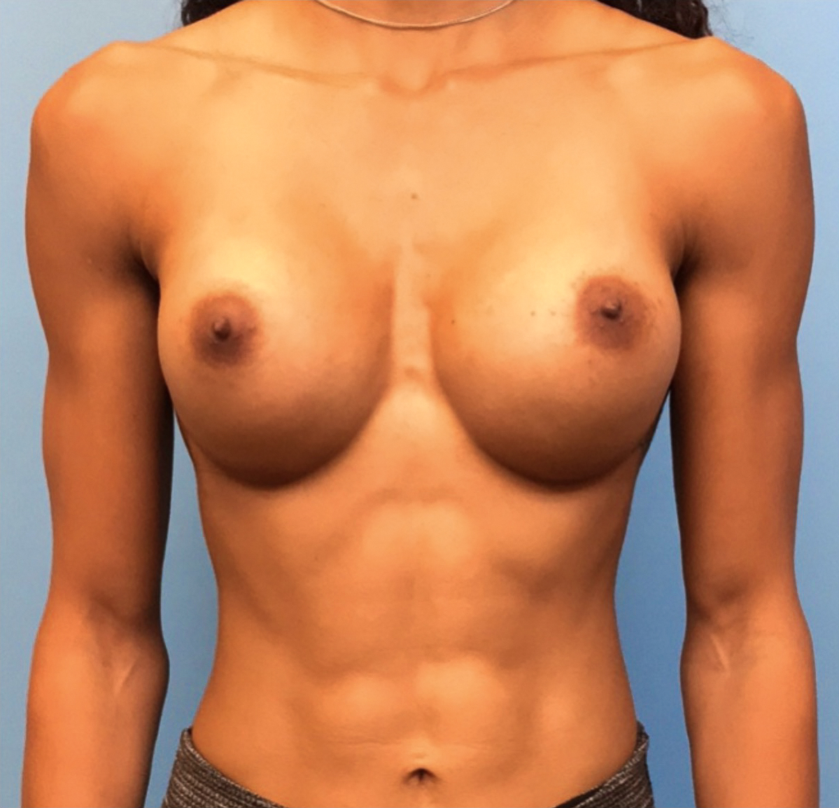 Breast-Augmentation-Case--221 | After Breast 1