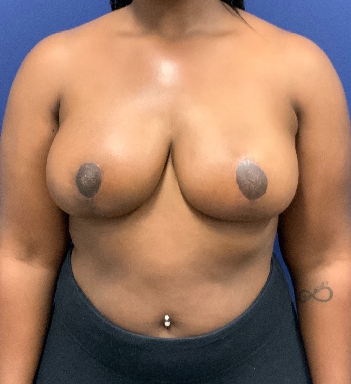 Breast-Reduction-Case--27530 | After Breast 1