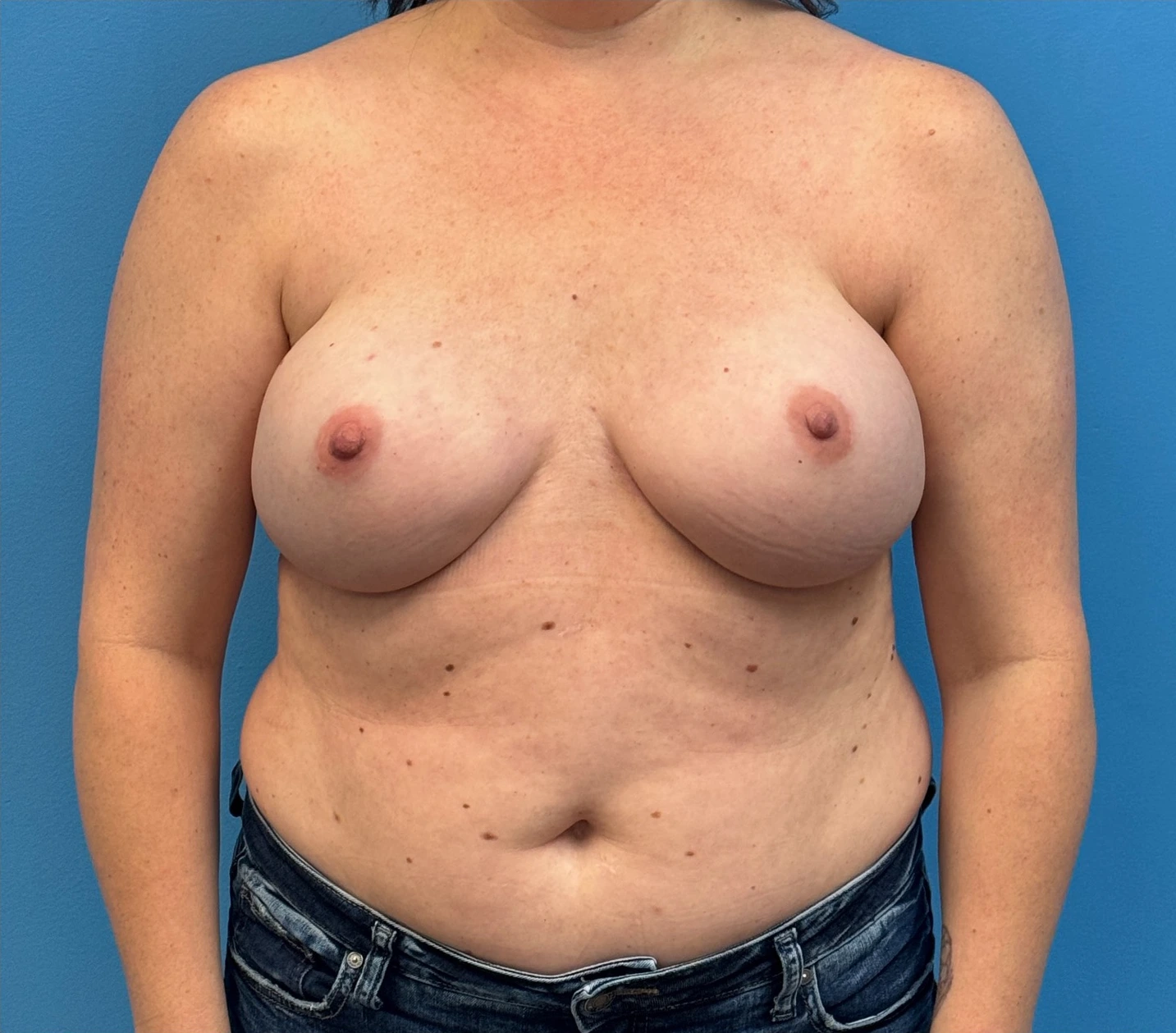 Breast-Reconstruction-Case--27065 | After Breast 1