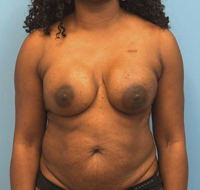 Breast-Reconstruction-Case--23930 | After Breast 1