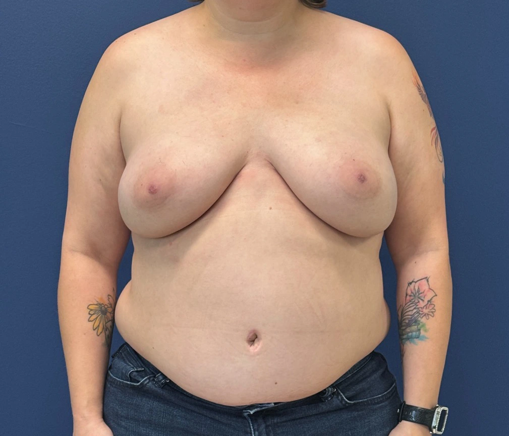 DIEP-Flap-Case--28021 | After Breast 1