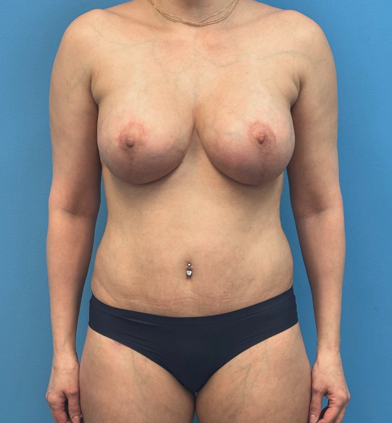 Breast-Augmentation-Tummy-Tuck-Case--28080 | After Breast 1