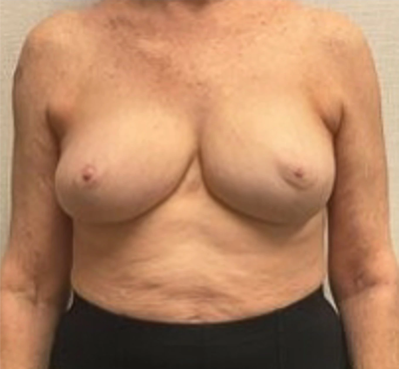 Breast-Reconstruction-Case--24804 | After Breast 1