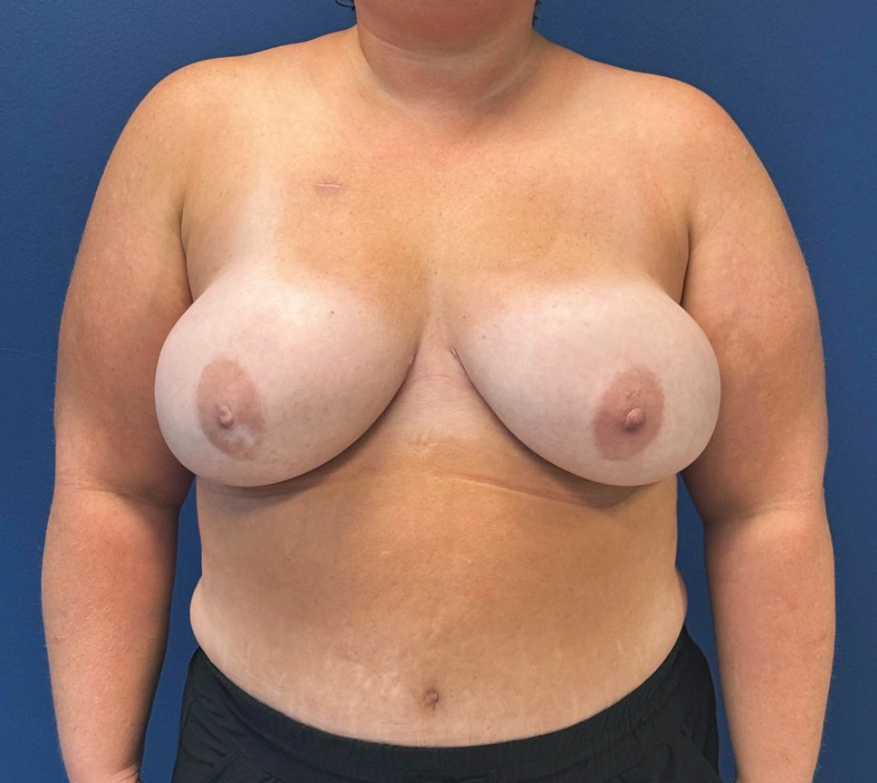 DIEP-Flap-Case--27595 | After Breast 1