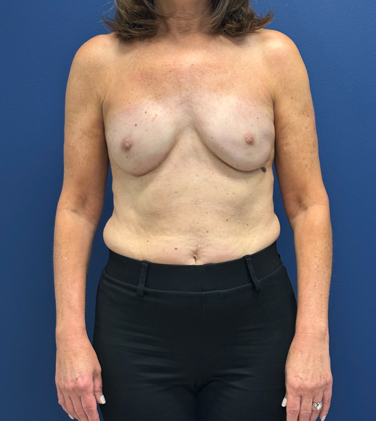 Breast-Reconstruction-Case--28688 | After Breast 1