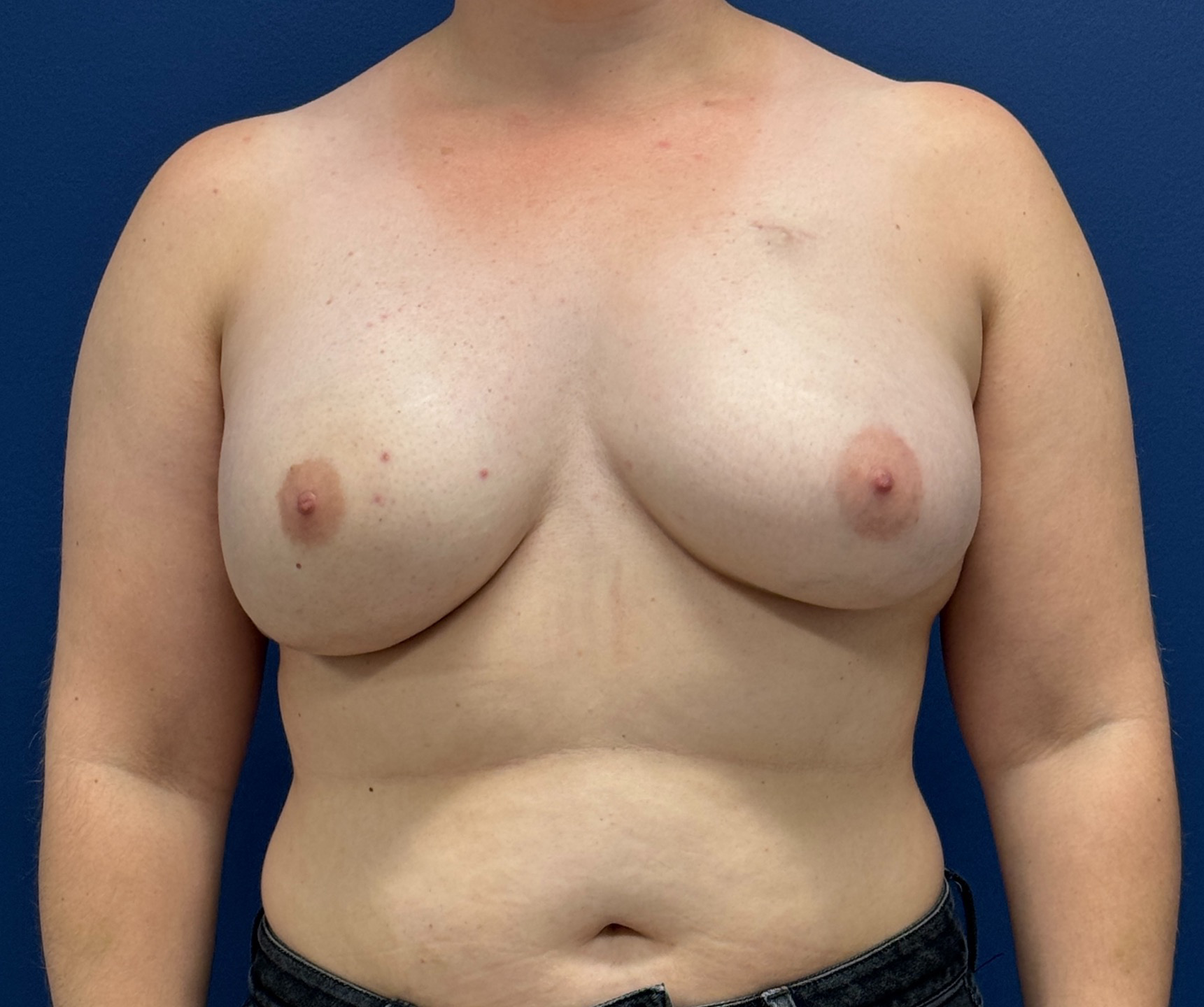 Breast-Reconstruction-Case--28689 | After Breast 1